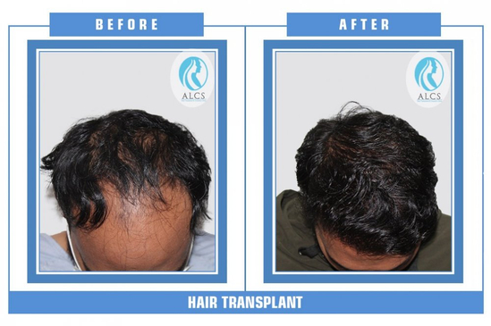 Slider image (2) ALCS - Hair Transplant &  Cosmetic Clinic